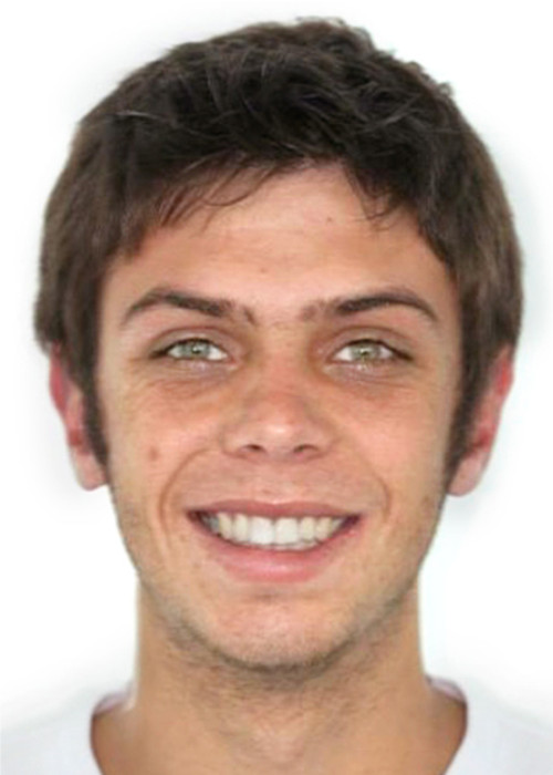 face_final - Caso Autotransplante