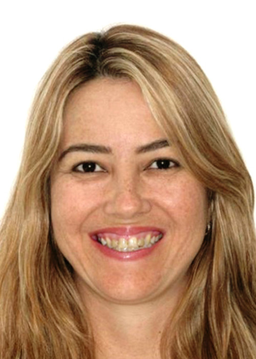 face_final - Extração de 4 Pré Molares