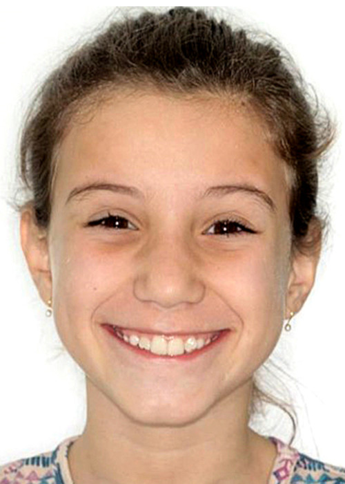 face_final - Mordida Cruzada Esquelética em Crianças