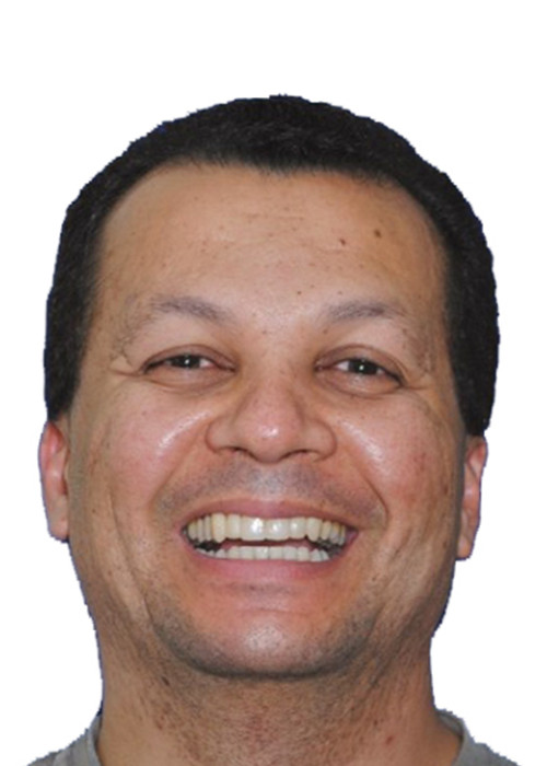 face_final - Tratamento em Adultos com Perda Óssea