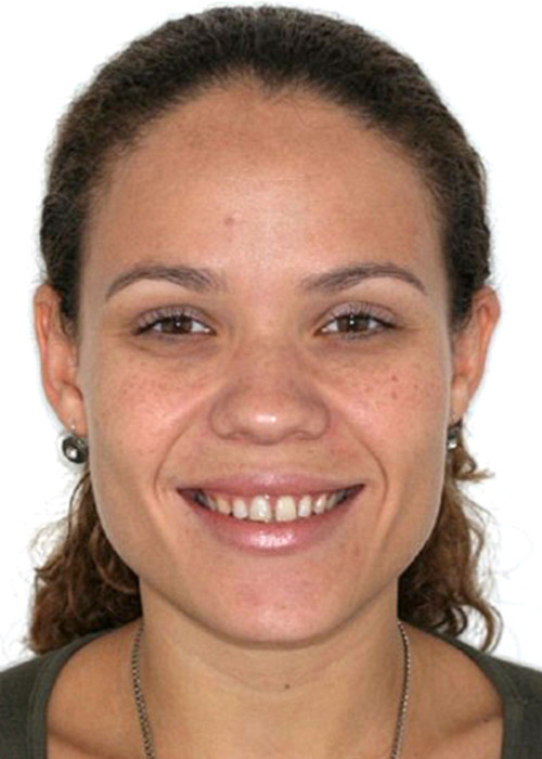 face_final - Diastemas - Espaço entre os dentes