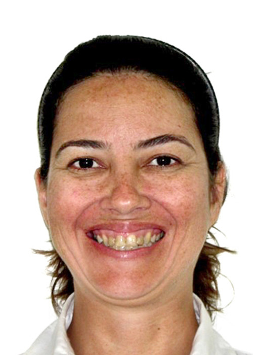 face_final - Extração de 4 Pré Molares