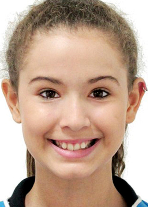 face_final - Falta de Espaço Disjunção Maxilar na Dentição Permanente