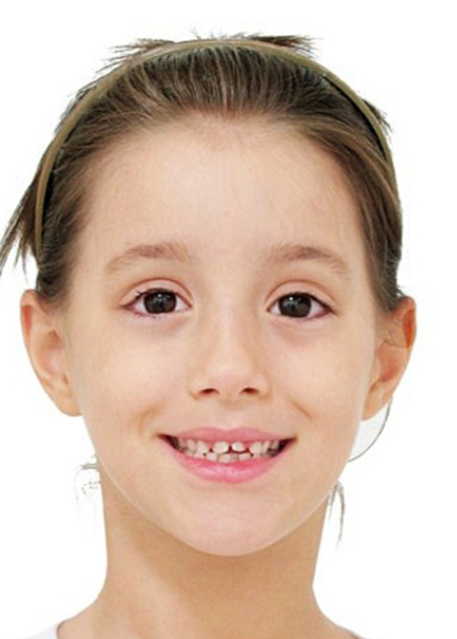face_final - Falta de espaço - Disjunção Maxilar na Dentição Mista