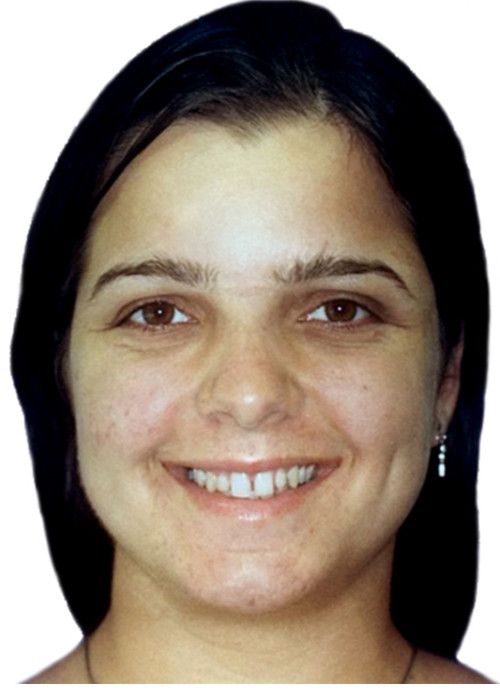 face_final - Implante em Dentes Anteriores por Agenesia de Laterais