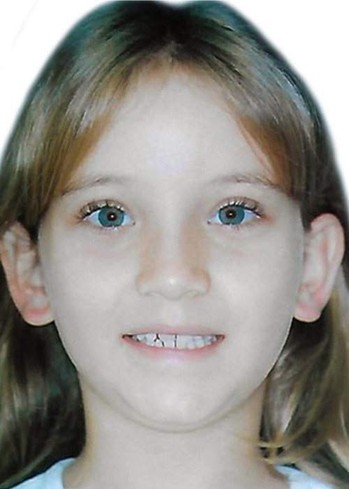 face_final - Mordida Cruzada Dentária Anterior