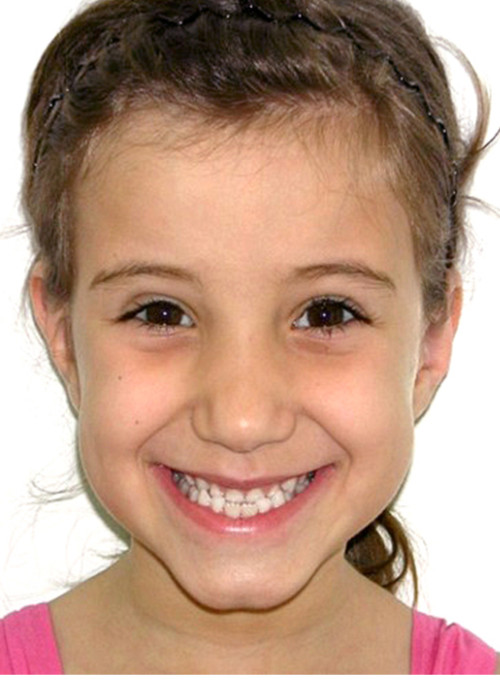 face_final - Mordida Cruzada Esquelética em Crianças