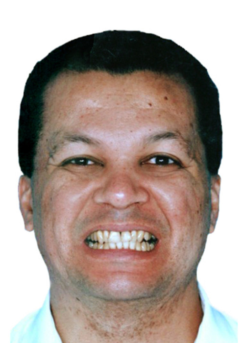 face_final - Tratamento em Adultos com Perda Óssea